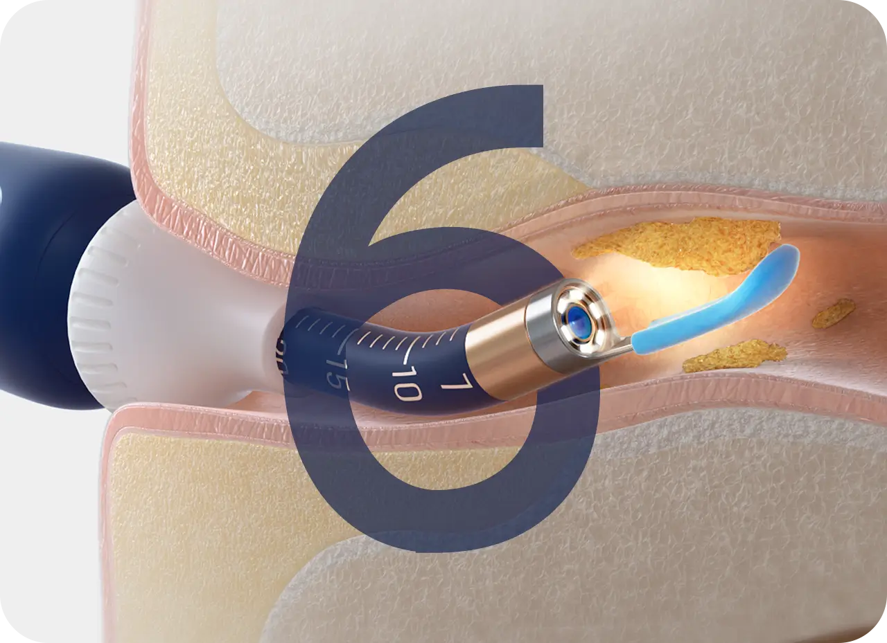 6 Things You Need to Know About Earwax Removal