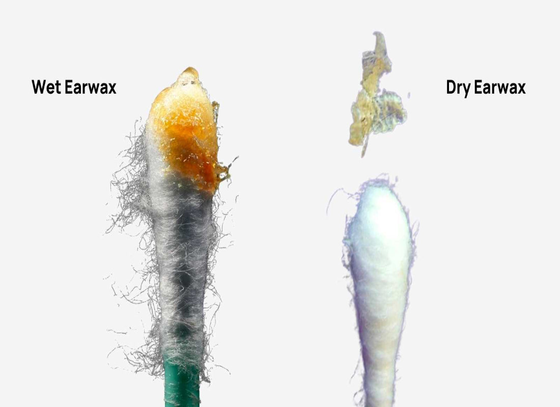 Wet vs Dry Earwax: What’s the Difference?