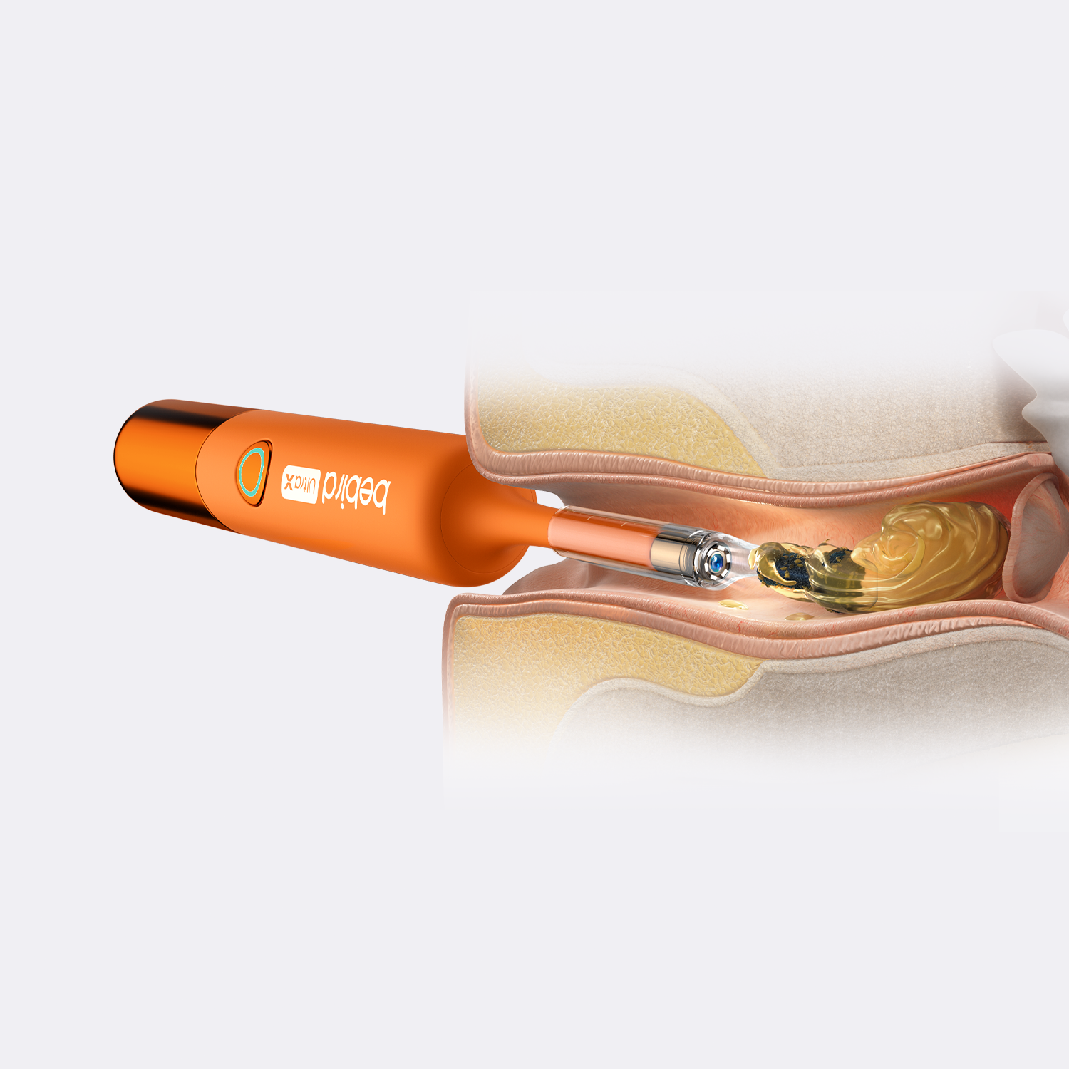 Bebird EarSight Ultra X（Exclusive Pre-Order）